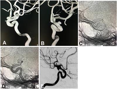 Small Unruptured Intracranial Aneurysms Can Be Effectively Treated With Flow-Diverting Devices